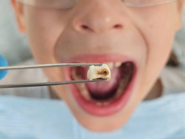 Best Emergency Tooth Extraction in Pacifi, CA